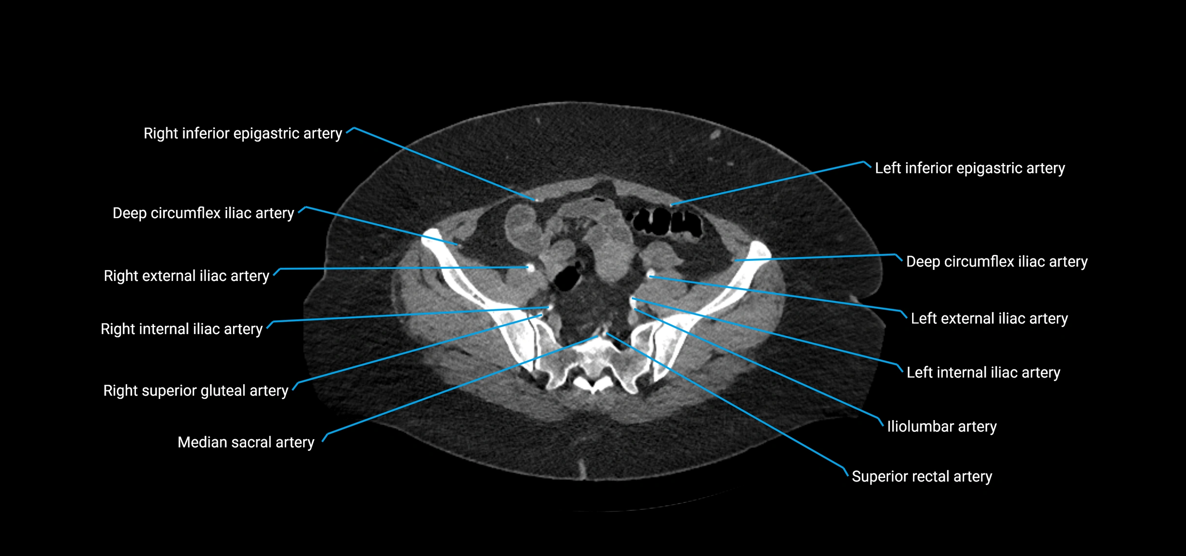 CTA abdomen axial cross sectional anatomy labelled image_199 (2).webp